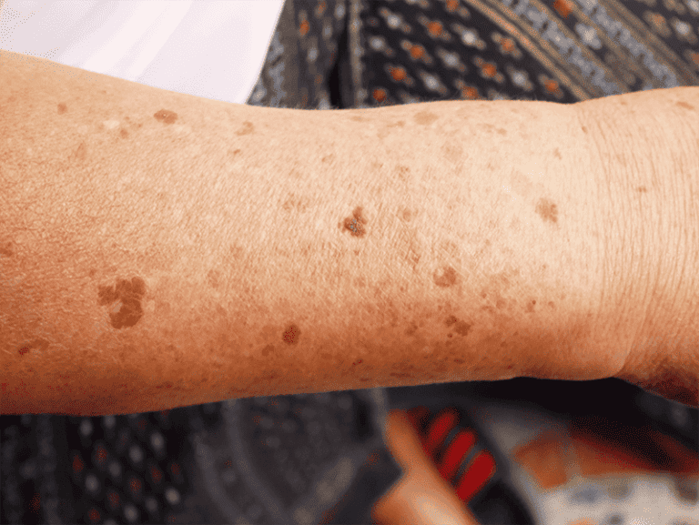 spots
